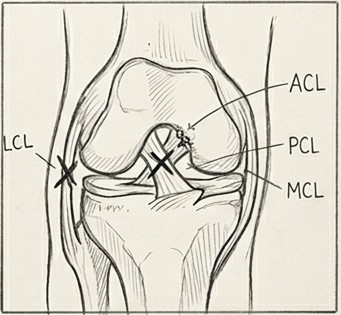 Dibujo de lesiones de ligamentos de rodilla