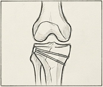 Dibujo de osteotomía de rodilla