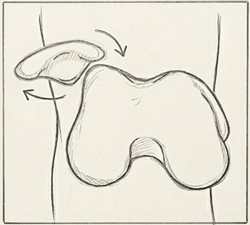 Dibujo de inestabilidad de rótula